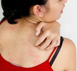 грануломи по тялото - симптоми за наличие на паразити