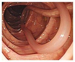 паразити в човешкото тяло