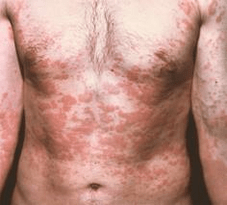 проблемната кожа е симптом за наличието на паразити