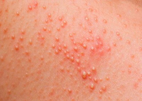Ако тялото е засегнато от паразити, се появява кожна алергия