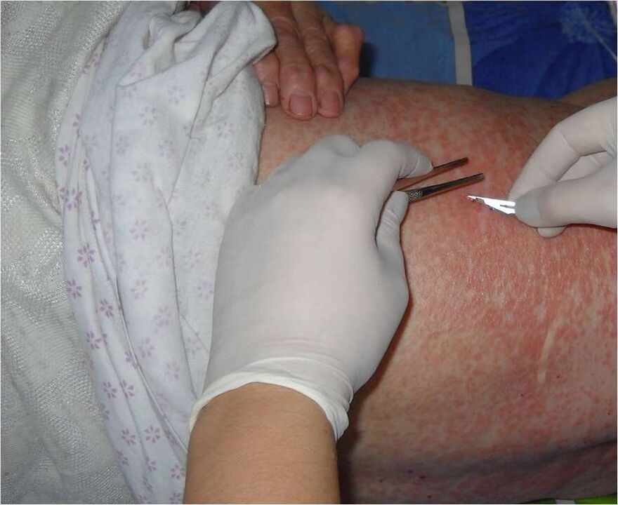 Остъргване на засегнатата област за откриване на паразити под кожата